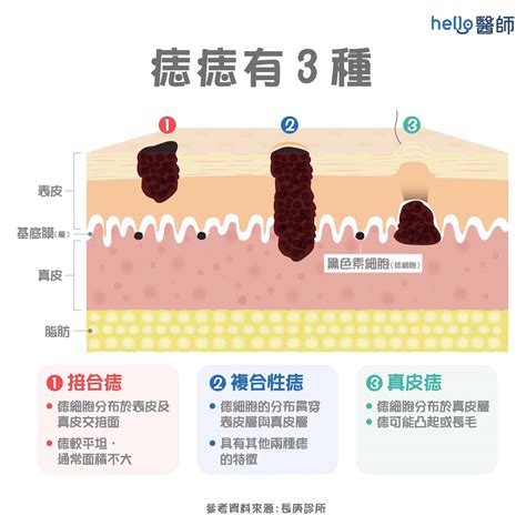 身體痣|痣變大、痣多或長毛會變皮膚癌？認識痣的形成與原因